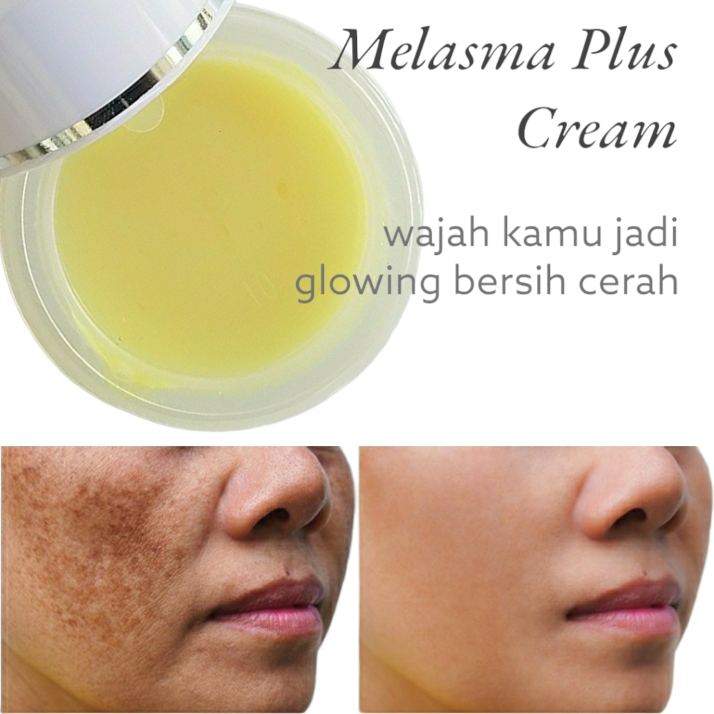 CREAM MELASMA DAN FLEK HITAM MELASMA PLUS