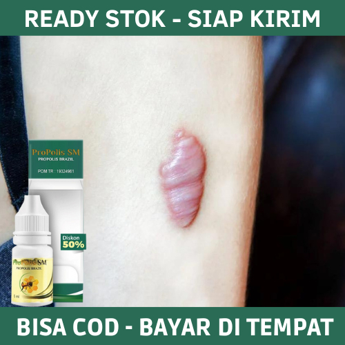 Obat Keloid, Obat Untuk Keloid, Obat Keloid di Telinga, Obat Keloid di Dada, Obat Keloid Parah, Obat