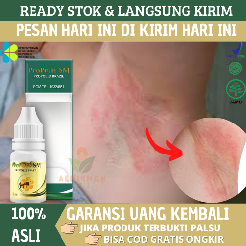 Obat Gatal Ruam & Iritasi Di Lipatan Ketiak, Obat Ketiak Gatal Biang Keringat Dan Menghitam Dengan P