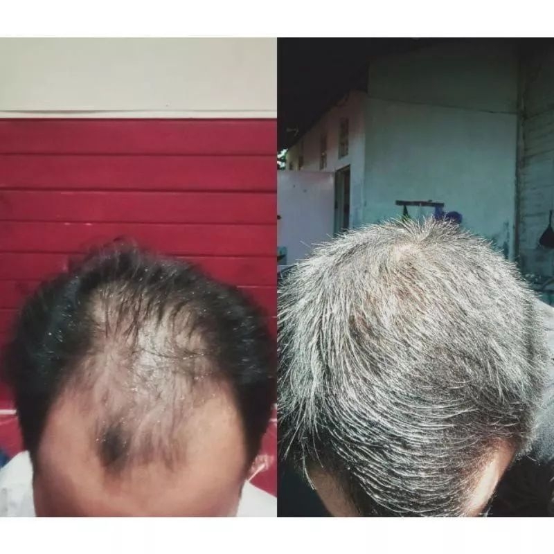 FINmix  Hair Serum Finmix SPESIALIS Ramut Asli Original Atasi Rambut  Botak