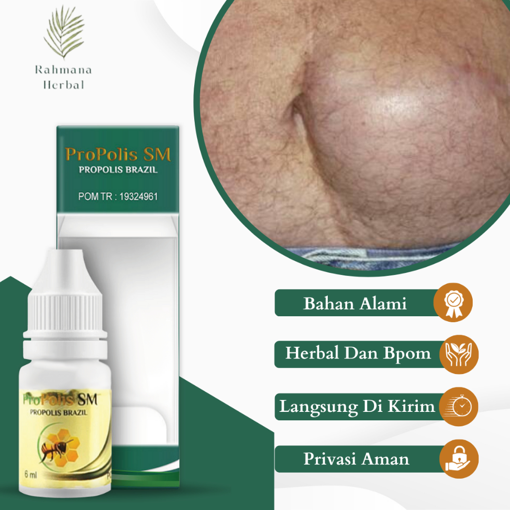Obat Hernia Turun Berok Pada Bayi, Obat Usus Turun, Hernia Inguinalis, Hernia Nukleus Untuk Anak Dan