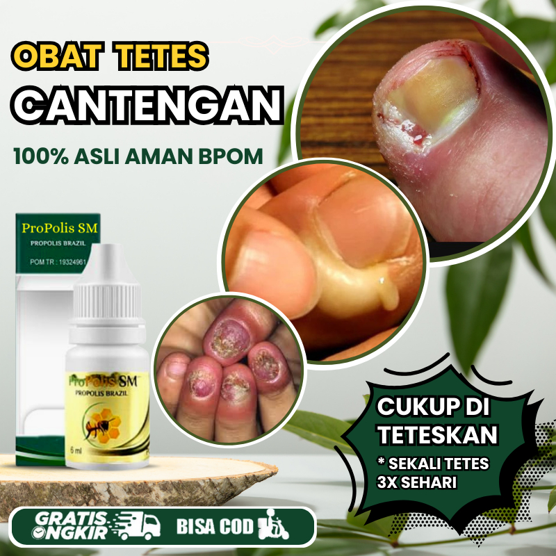 Obat Tetes Menyembuhkan Cantengan Anak & Dewasa, Jempol Kaki Cantengan Parah, Obat Cantengan Bengkak