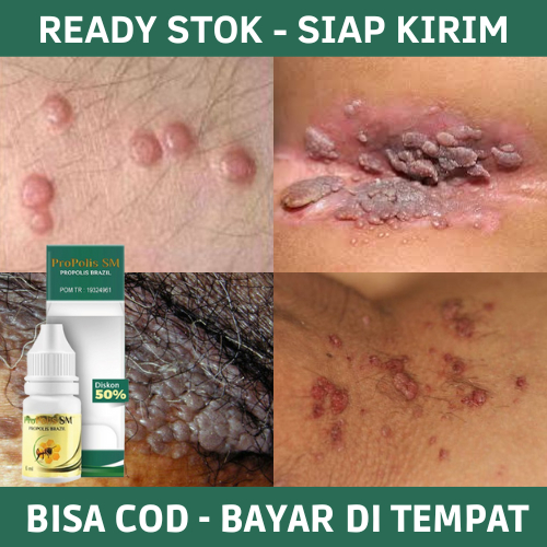 Obat Kutil Kelamin - Obat Kutil Anus Pria Wanita - Obat Daging Tumbuh Pada Kelamin - Obat Perontok K