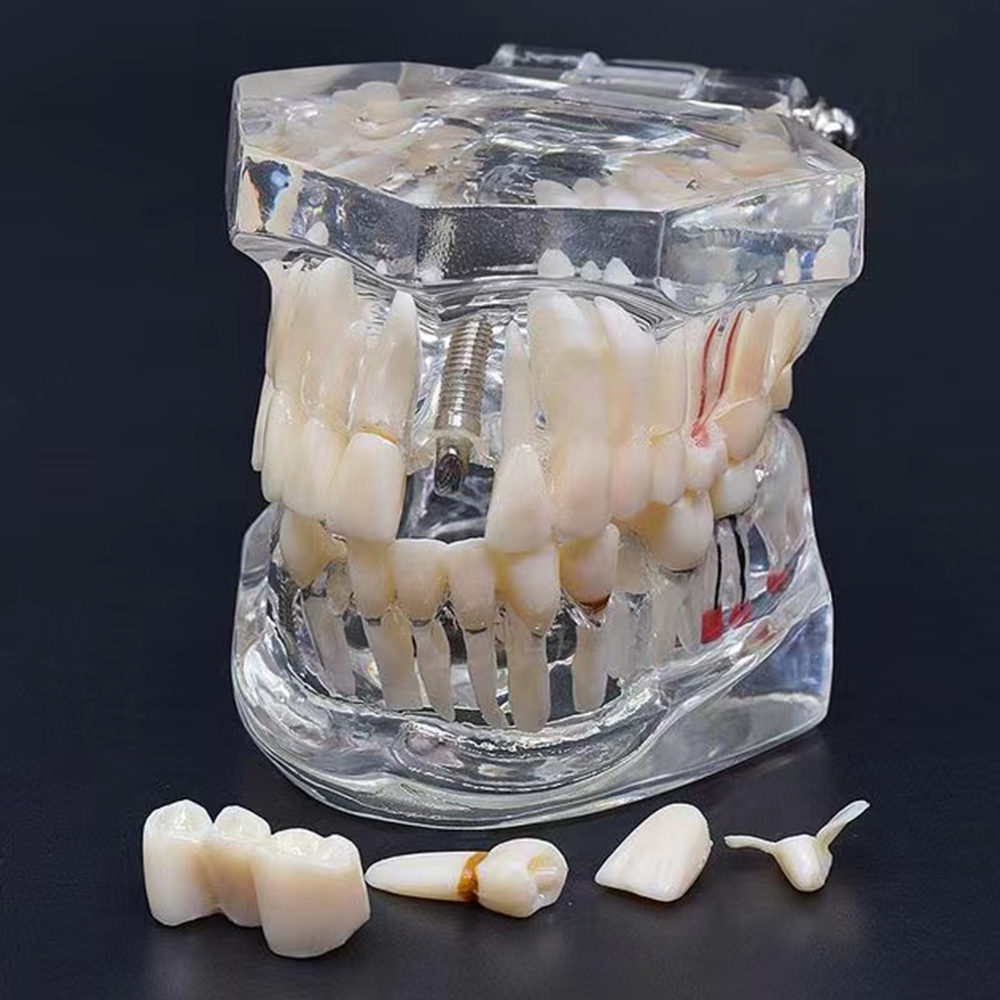 Model Study Gigi Edukasi Transparan Studi Implant Phantom Crown Karies Bridge Bening Impaksi Model
