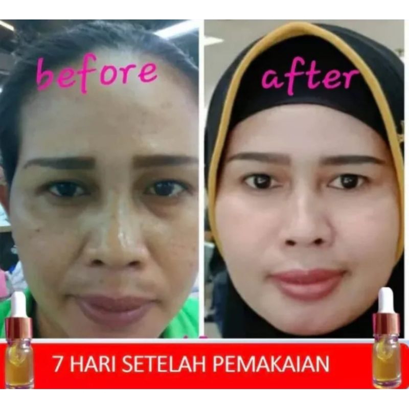serum flek hitam membandel bpom | serum penghilang flek hitam dan glowing | serum flek hitam dan amp