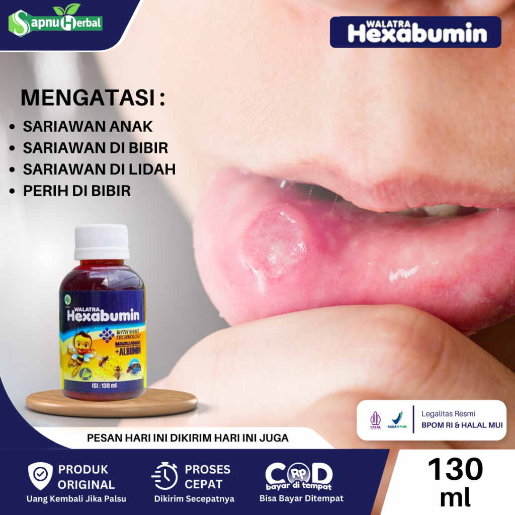 Obat Sariawan di Lidah Anak, Sariawan Di Bibir, Lidah Putih Pada Bayi, Lidah Jamuran, Perih Di Lidah