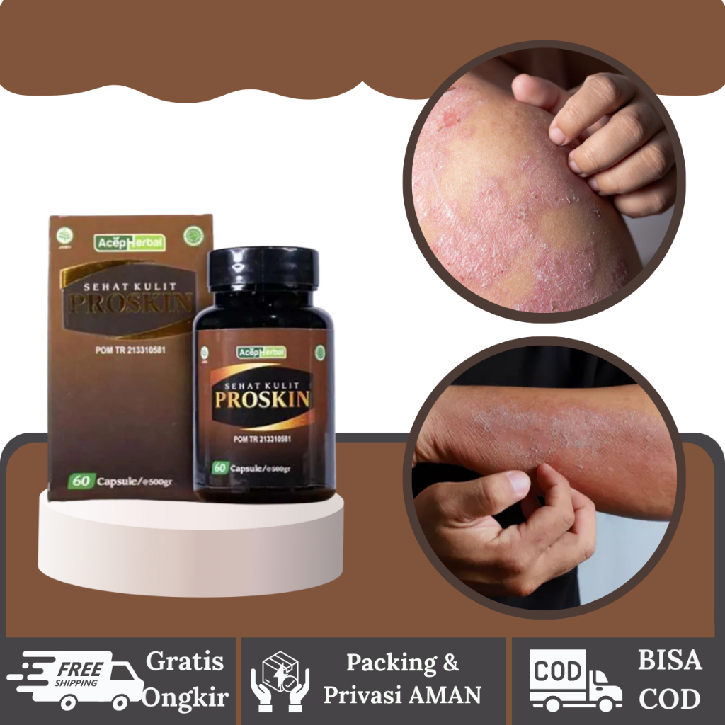 Obat Obat Gatal Eksim,Obat Gatal Eksim Kering Menahun, Obat Kulit Gatal2 Eksim Kering Menahun,  Obat