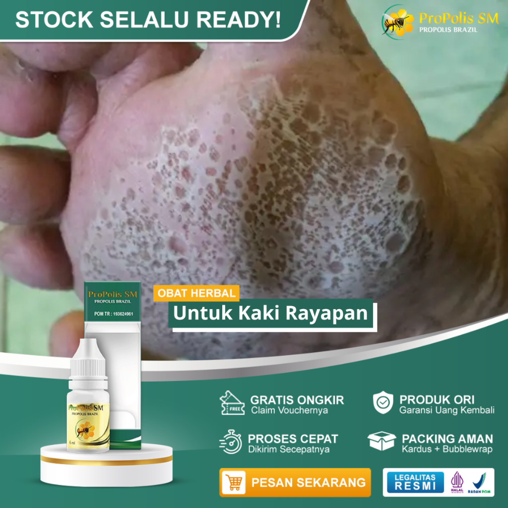 Obat Kaki Rayapan, Obat Telapak Kaki Rayapan Bolong, Obat Telapak Kaki Bau, Obat Rayapan Di Kaki, Ob