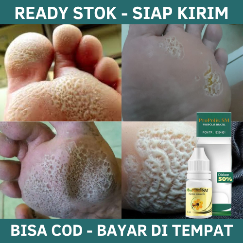 Obat Kaki Rayapan, Obat Kaki Rayapan dan Bau, Obat Kaki Bolong-Bolong, Obat Oles Kaki Rayapan, Telap