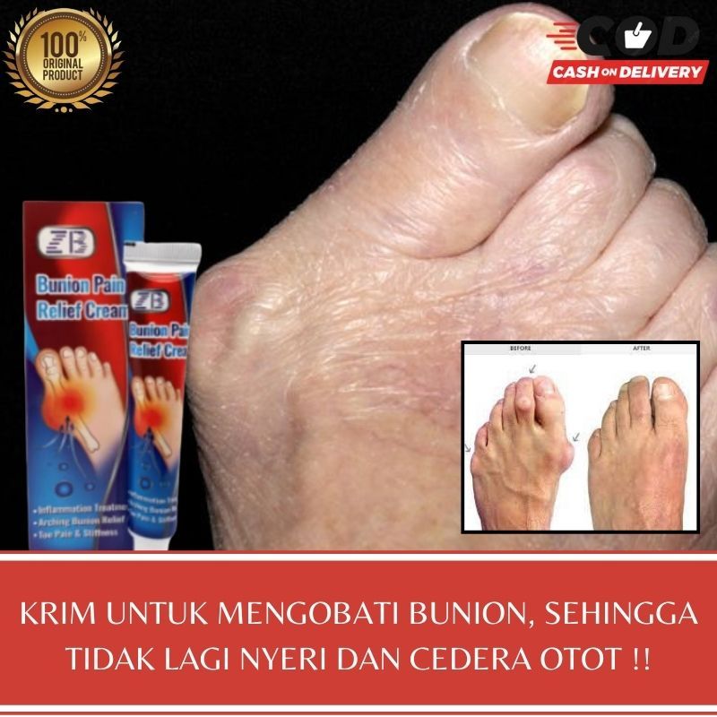 Bunion Cream Salep Pereda Pengempis Bunion Radang Sendi