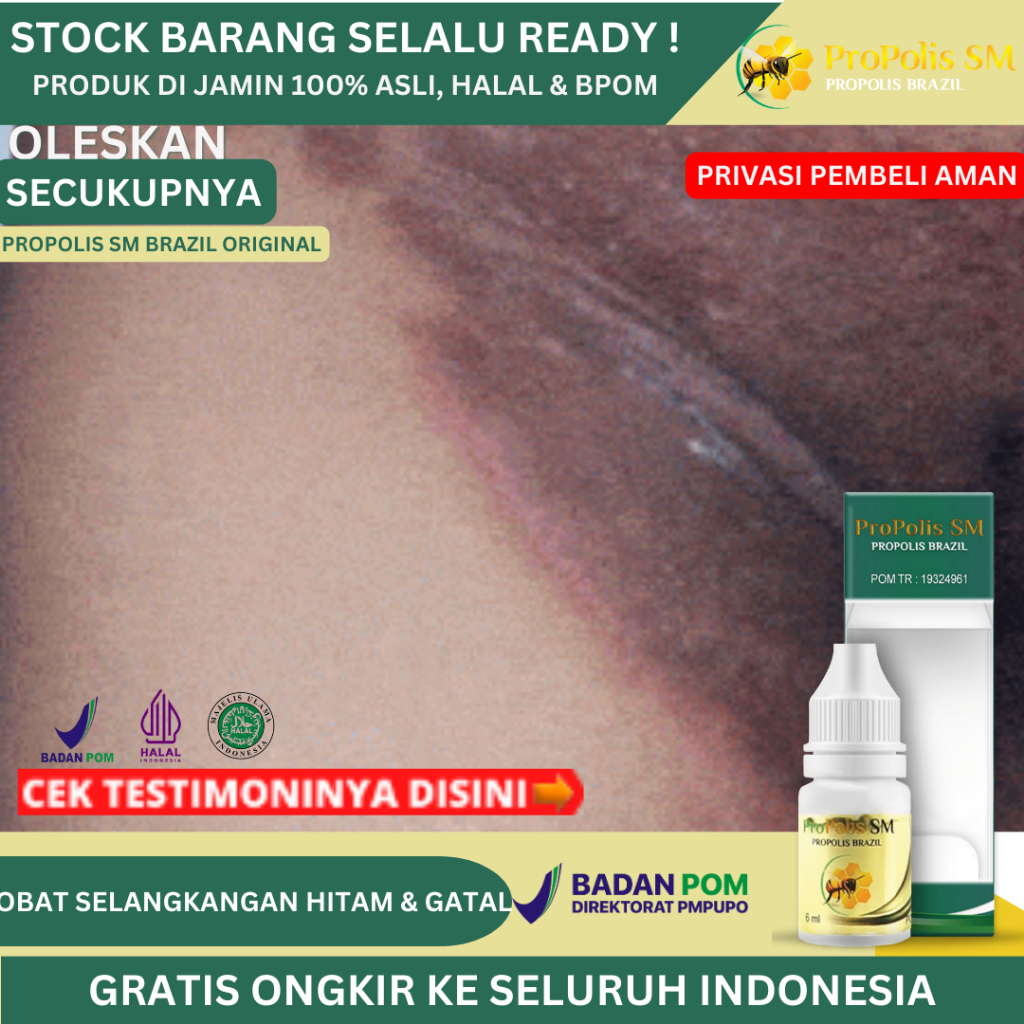 Obat Selangkangan Hitam Dan Gatal, Obat Penghilang Gatal Selangkangan, Obat Jamur Selangkangan, Obat