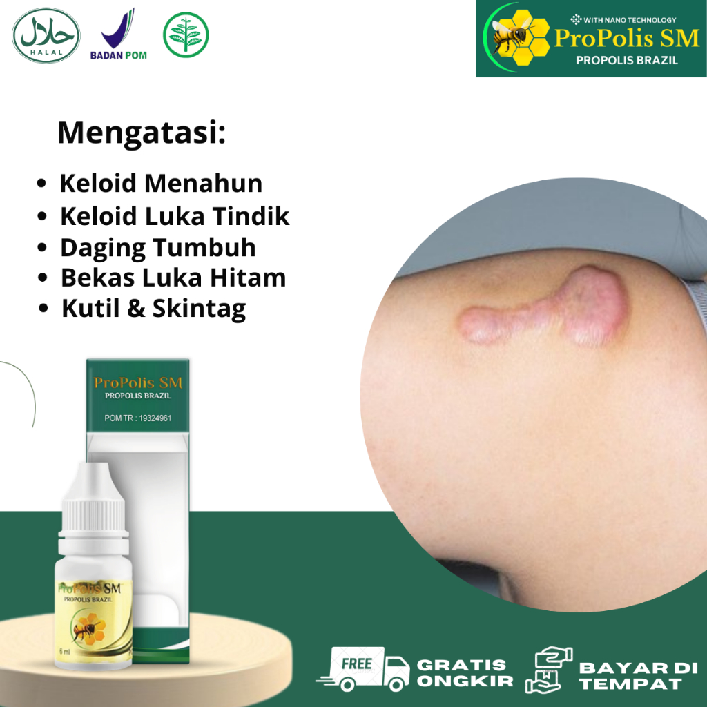 Propolis Keloid, Obat Keloid Luka Tindik, Penumpas Daging tumbuh, Penghilang Keloid Yang Sudah Lama,