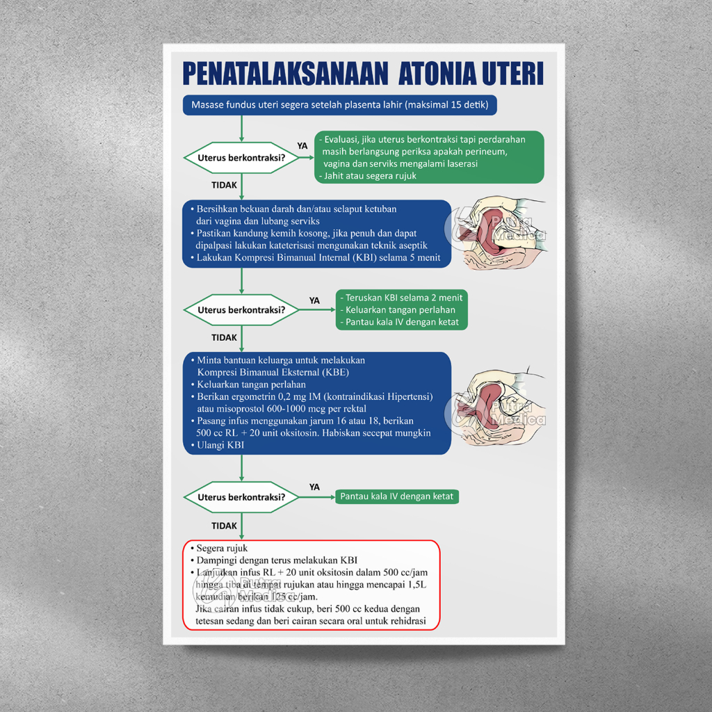Poster Kesehatan Penatalaksanaan Atonia Uteri A3+ / Gambar Edukasi Kebidanan / Tata Laksana Penangan