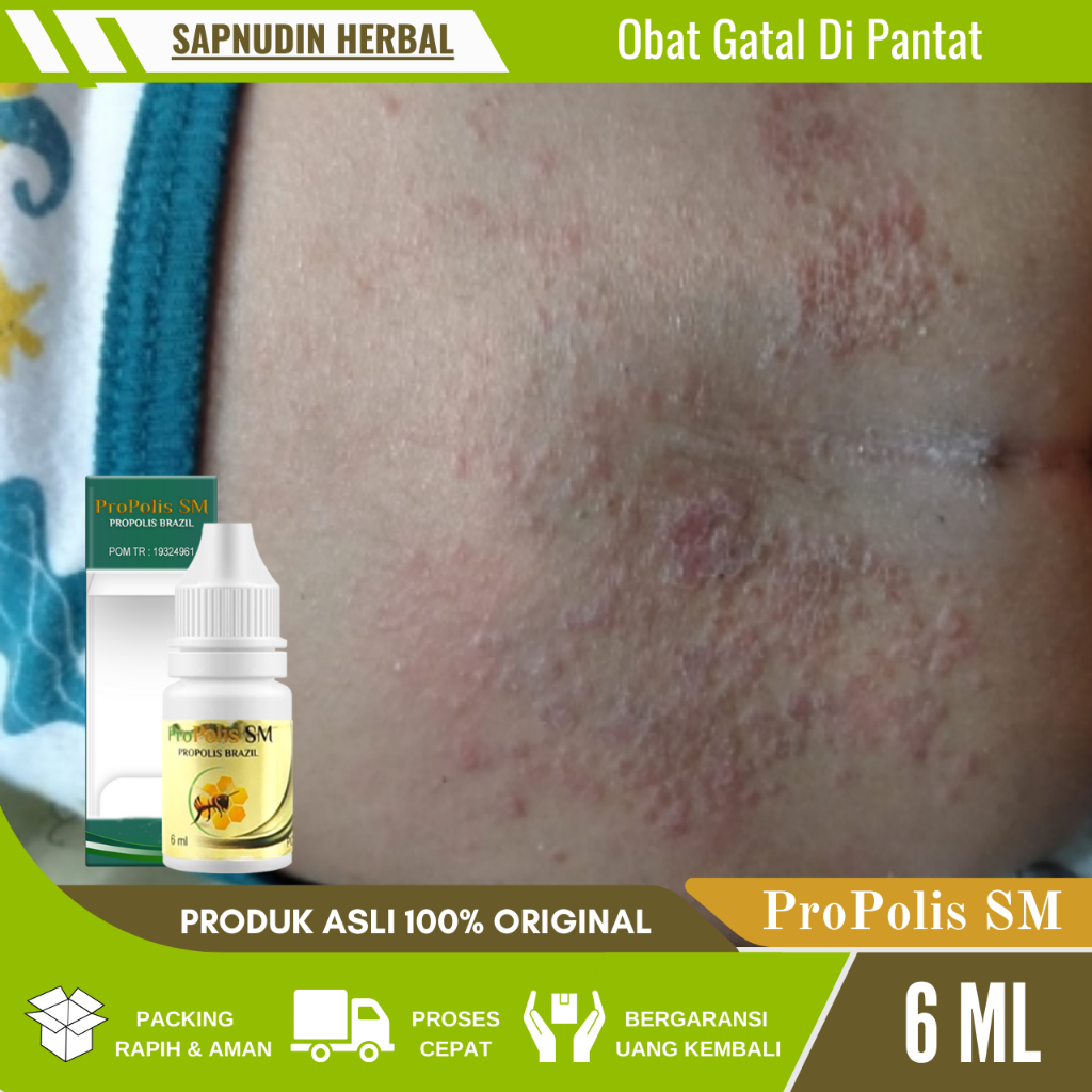 Obat Gatal Dan Hitam Di Pantat, Obat Gatal Pantat Dewasa, Obat Pantat burik Gatal, Obat Gatal Jamur 