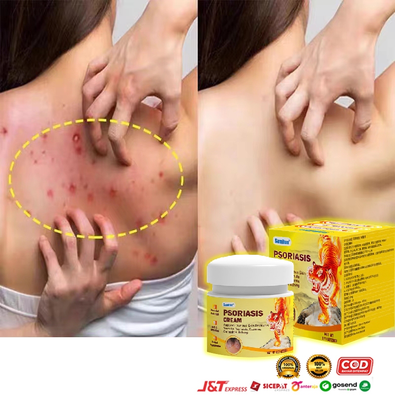 salep jamur kulit salep eksim salep gatal paling ampuh 20g salep gatal Kulit Kepala Psoriasis Tangan