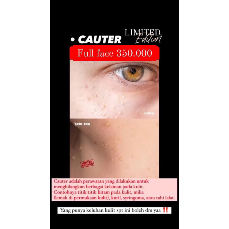 cauter full wajah/leher