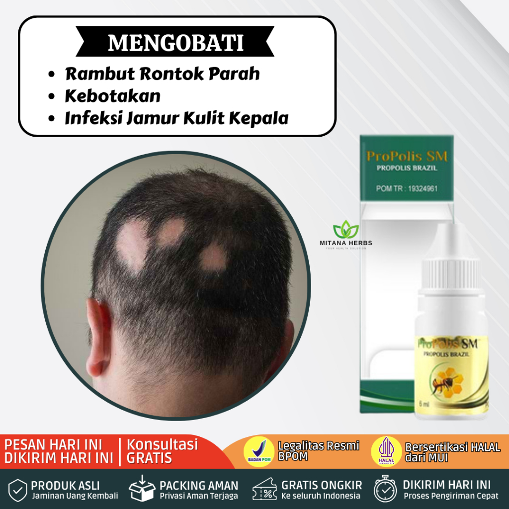 Obat Alopecia Penumbuh Rambut Rontok Penambah Rambut Alopecia Areata Infeksi Jamur Kulit Kepala