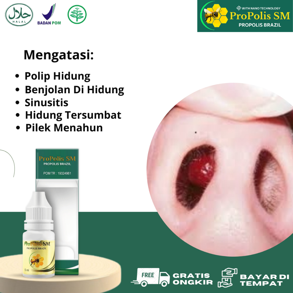Obat Polip Hidung, Benjolan di Hidung, Pilek Menahun, Penghancur Polip Hidung, Hidung Tidak Bisa Men