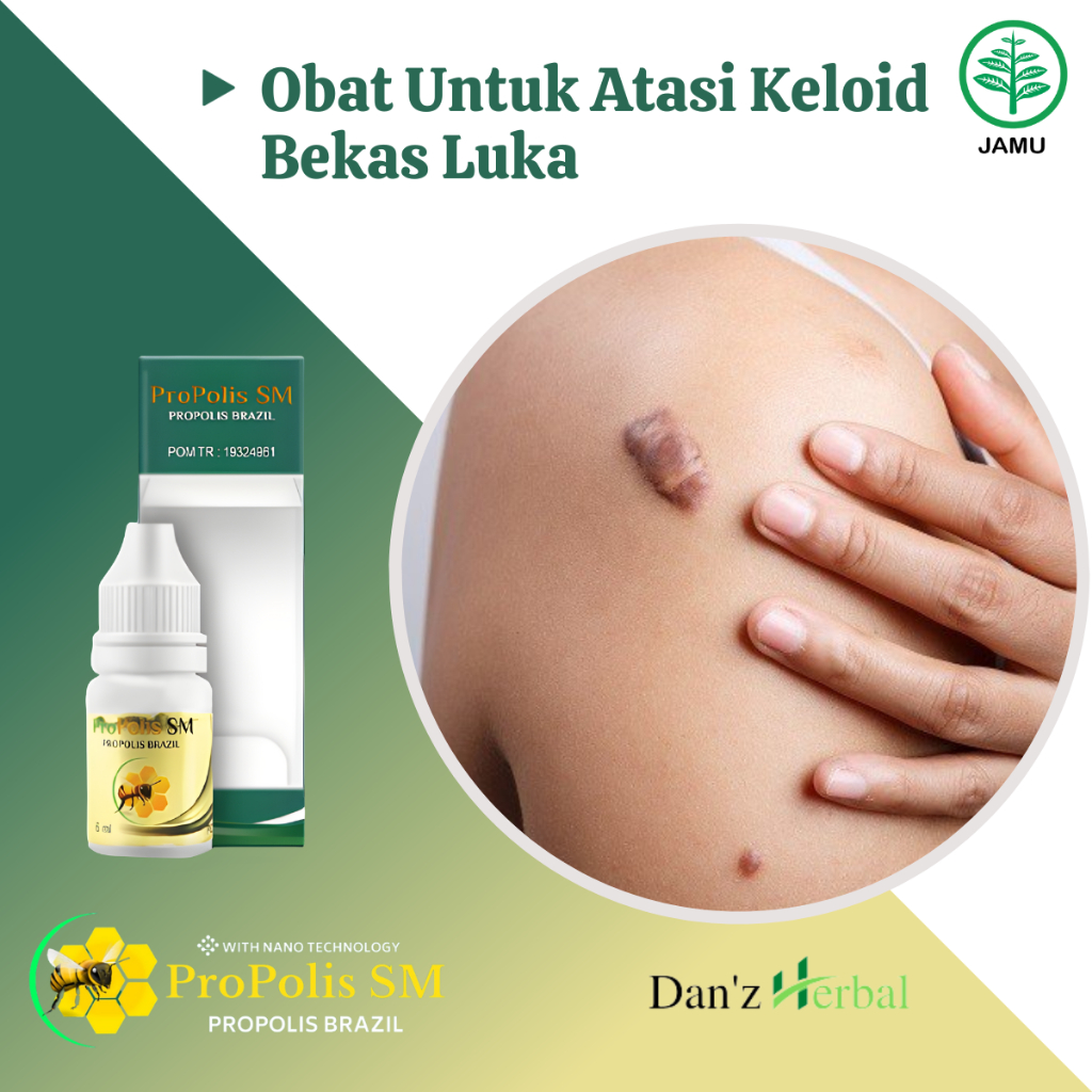 Obat Keloid Daging Tumbuh Daging Jadi Penghilang Bekas Luka Menonjol Obat Keloid Bekas Operasi Keloi