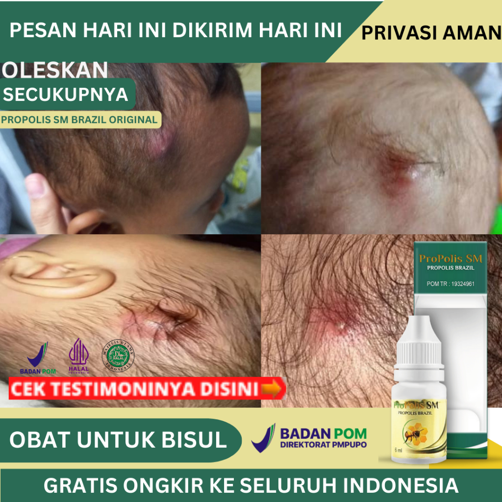 Obat Bisul Di Kepala, Bisul Bernanah, Obat Bisulan, Obat Bisul Di Kepala Anak, Obat Bisul Untuk Bayi