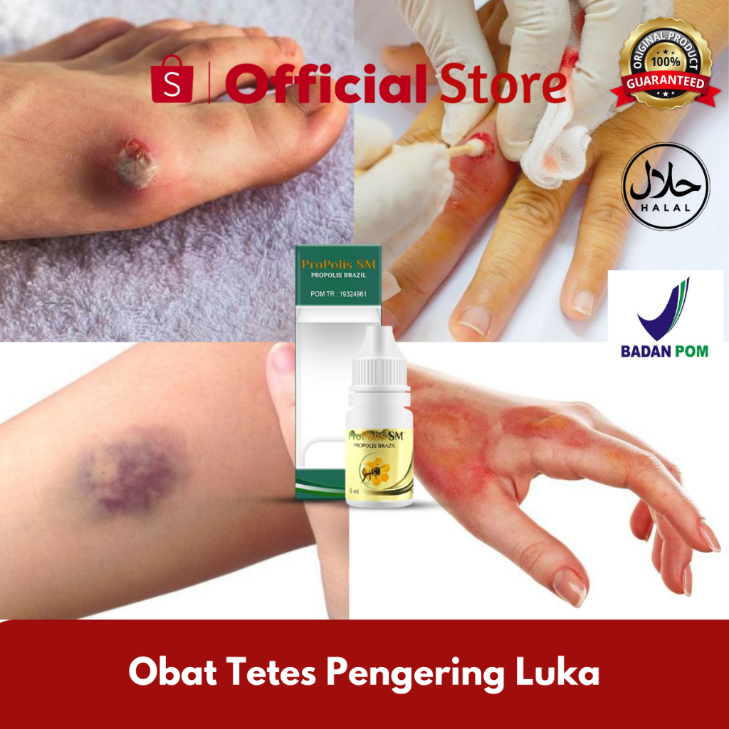 Obat Pengering Luka, Obat Luka Bakar, Obat Luka Bernanah, Obat Luka Diabetes, Obat Luka Memar, Obat 