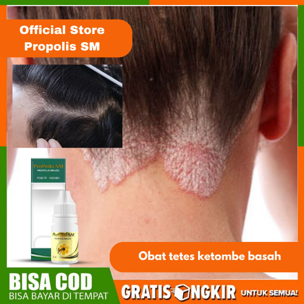 Obat Ketombe, Obat Ketombe Parah Berkerak Bersisik, Obat Penghilang Ketombe, Obat ketombe Rambut, Ob