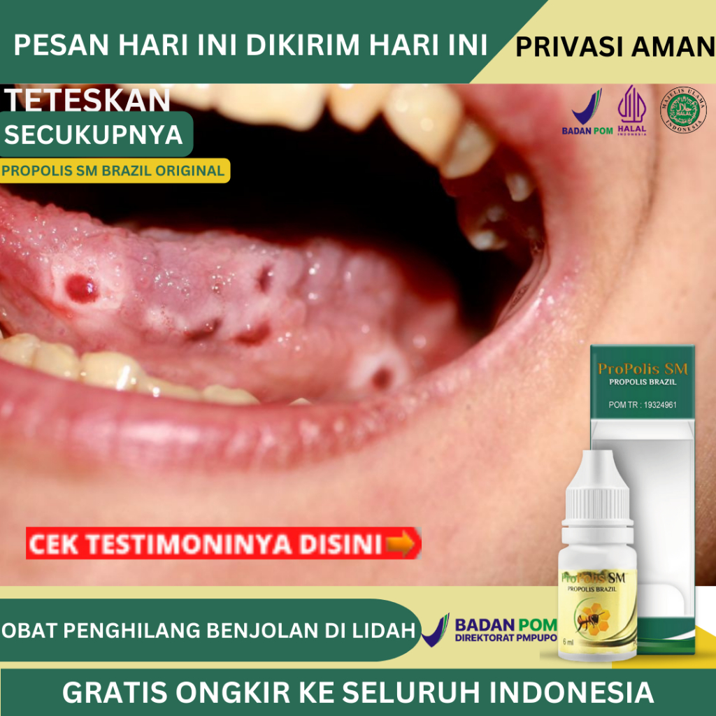 Obat Benjolan Di Lidah, Obat Mukokel, Benjolan Di Bawah Lidah, Kutil Di Lidah, Tumor / Kanker Lidah,