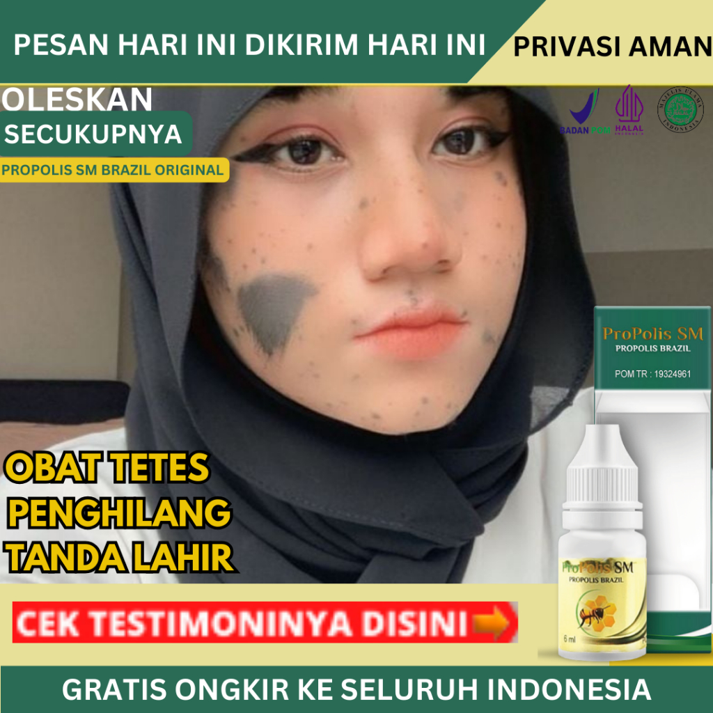 Obat Penghilang Tanda Lahir, Penghilang Noda Hitam Di Muka, Penghilang Hemangioma,  Obat Tanda Lahir
