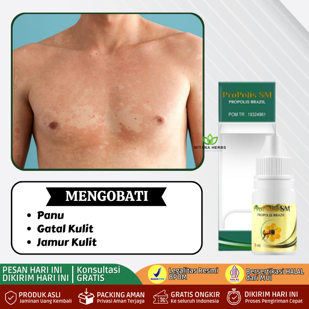 Obat Panu, Obat Penghilang Panu, Obat Panu Cair, Obat Jamur Kulit Panu, Obat Gatal Panu, Obat Panu D