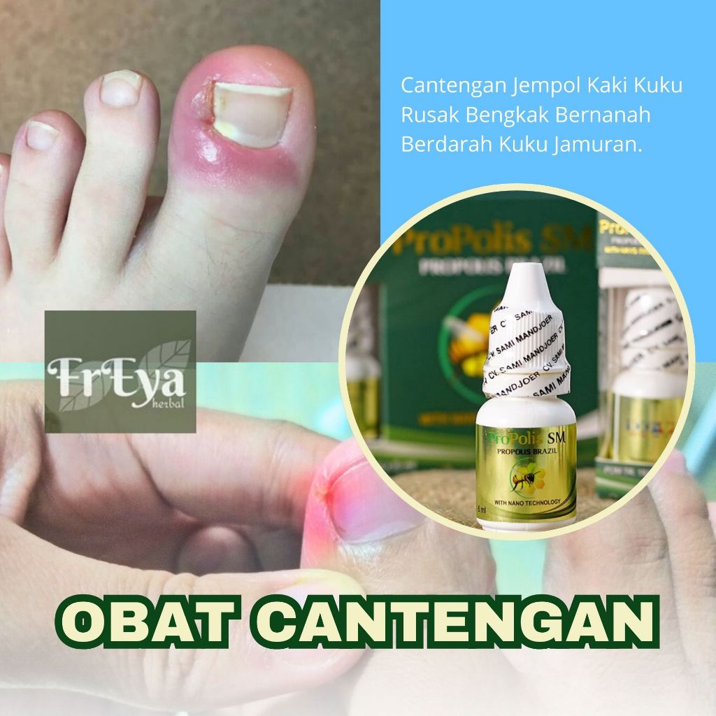 Obat Cantengan Jempol Kaki Kuku Rusak Bernanah Bengkak Bernanah Nyeri Bau Busuk Jamur Kuku Kaki