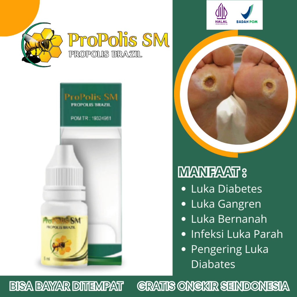 Obat Luka Diabetes, Obat Luka Diabetes Agar Cepat Kering, Obat Pengering Luka Diabetes, Obat Luka Di