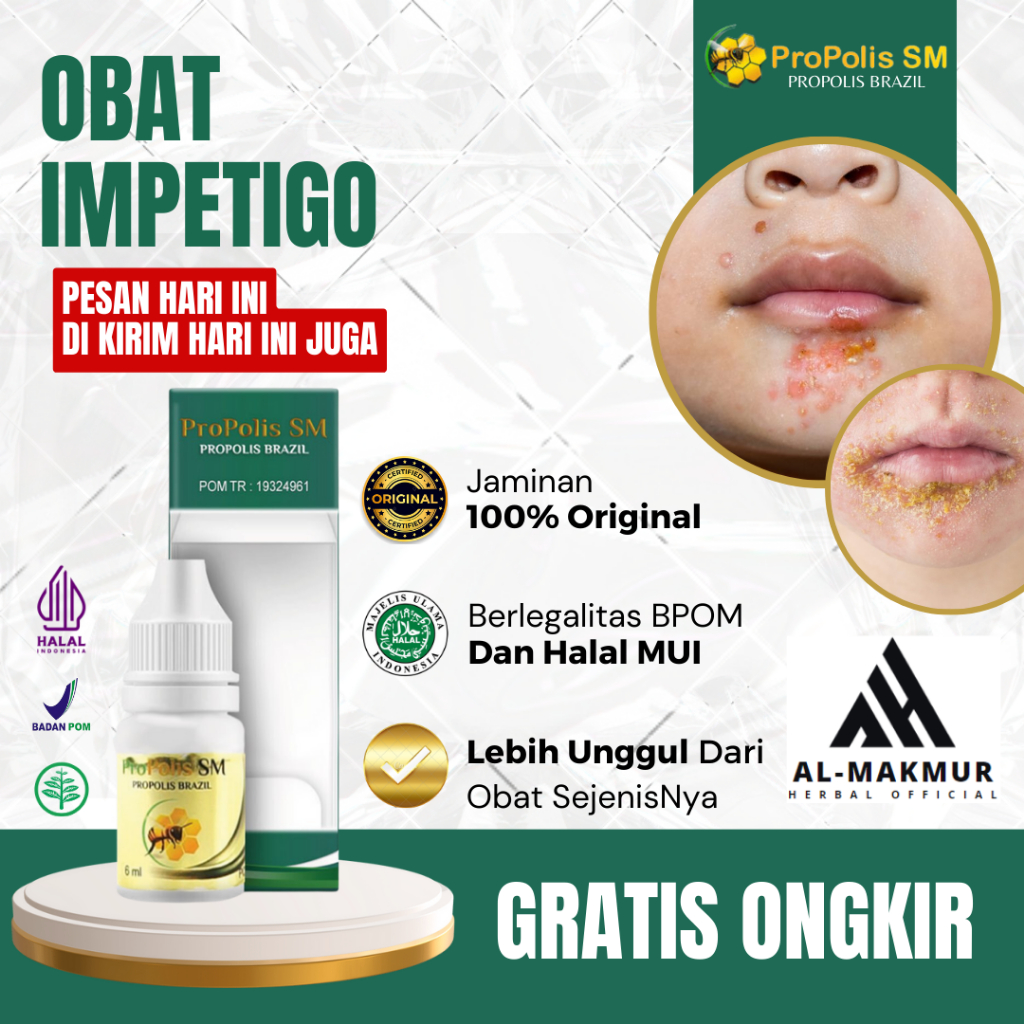 Obat Impetigo, Obat Kulit Melepuh, Obat Kulit Ruam Iritasi, Obat Kulit Luka Bercak, Obat Impetigo Be