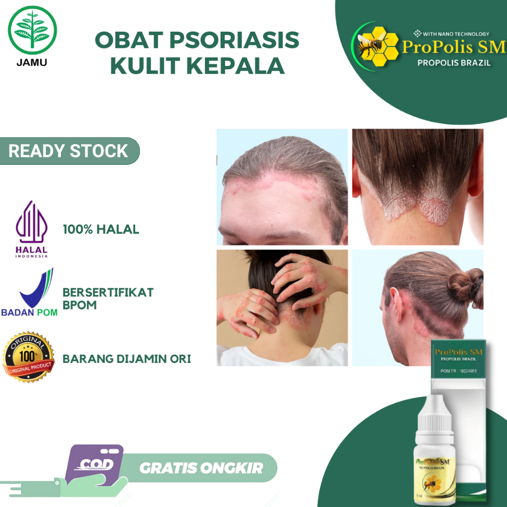 Obat Psoriasis Kulit Kepala Kering Berkerak Bersisik Kulit Kepala Gatal Obat Gatal Jamur Kepala PALI