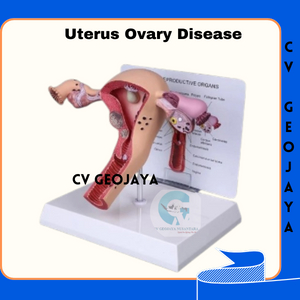 Manekin Alat Peraga Model Anatomi Human Female Uterus Ovary Disease - Ready Stock