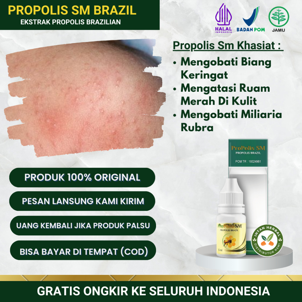 Propolis SM - Obat Biang Keringat, Gatal Biang Keringat, Miliaria Rubra, Bintik Bintik Merah Di Kuli