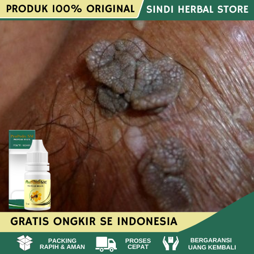 Obat Kutil Kelamin, Obat Kutil Kelamin Pria Wanita, Obat Kutil Kemaluan, Obat Penghilang Kutil di Al