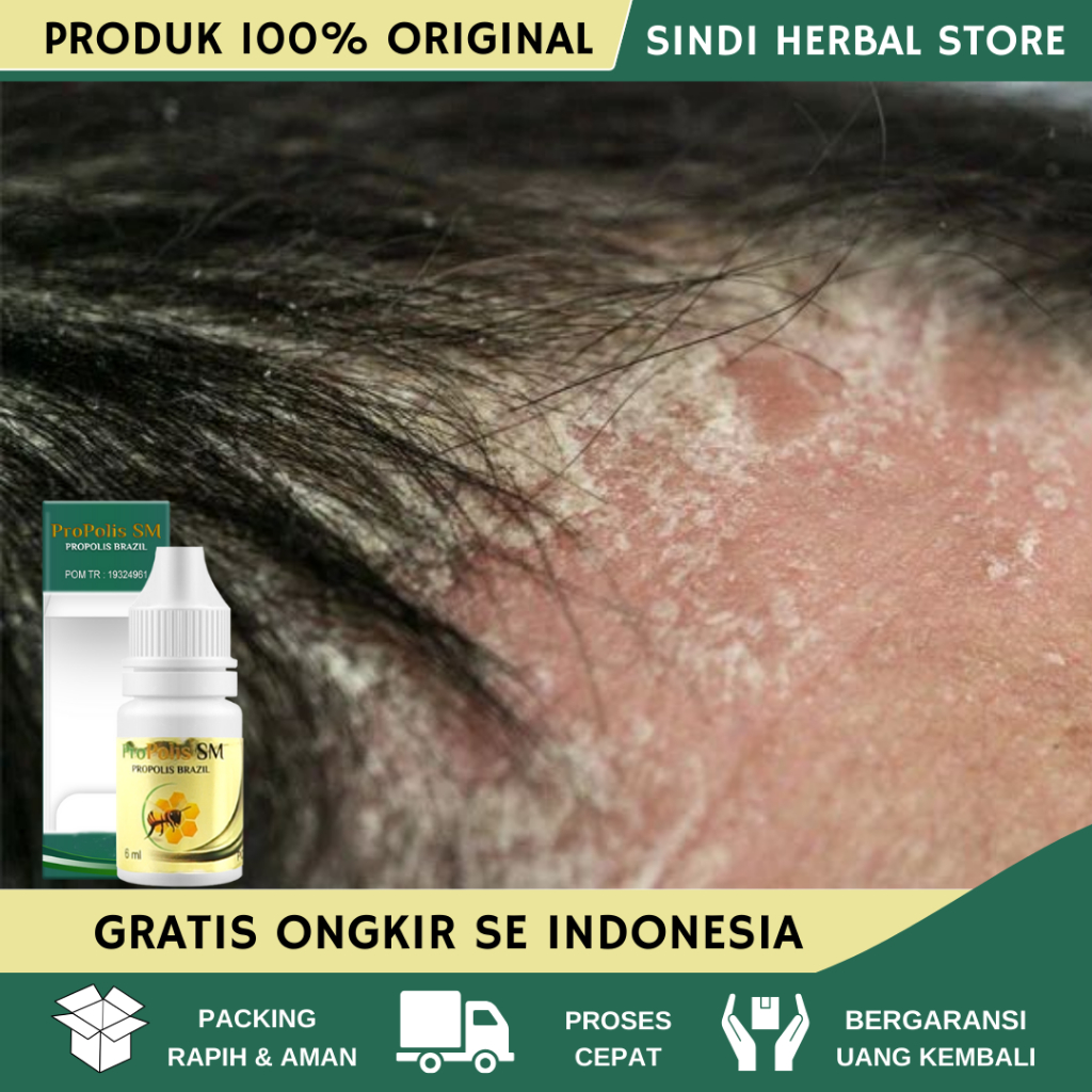 Obat Ketombe - Obat Ketombe Rambut - Obat Ketombe Berkerak - Obat Ketombe Parah - Obat Ketombe Dan R