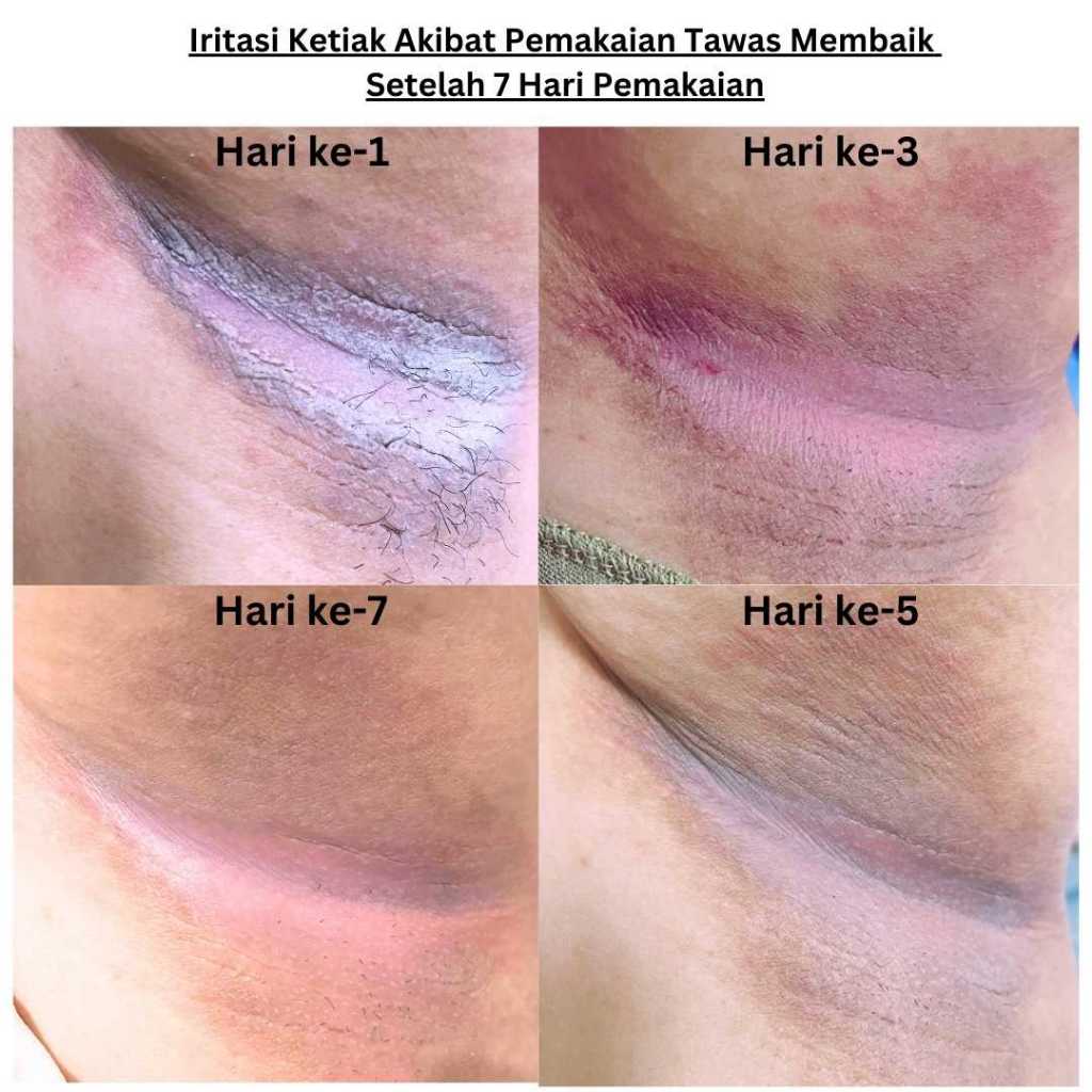 AMND Psogreen Salep Gatal Ampuh Selangkangan,Ketiak,Eksim,Infeksi Jamur,Psoriasis,Aman Bumil Busui