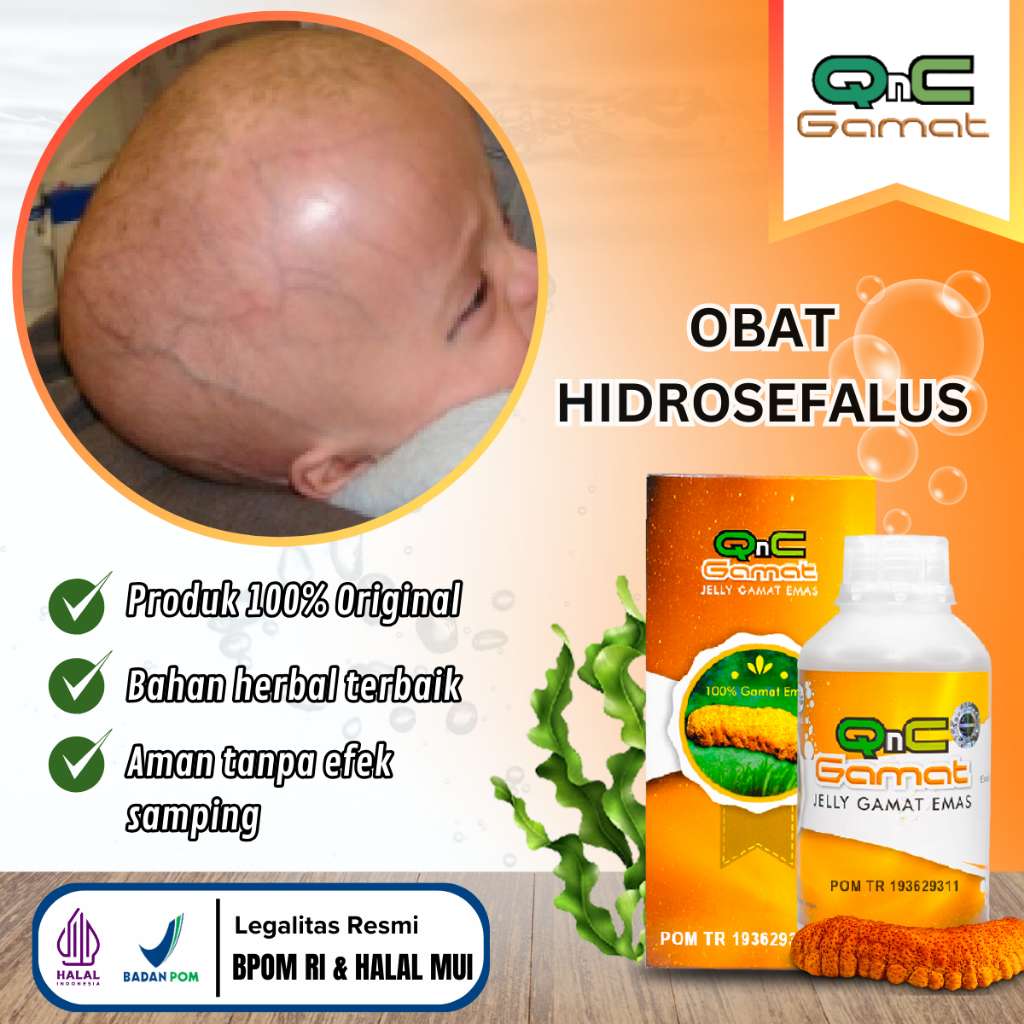 Obat Hidrosefalus / Hydrocephalus, Penghilang Cairan Di Otak, Hidrosefalus Anak, Sakit Kepala Pada A