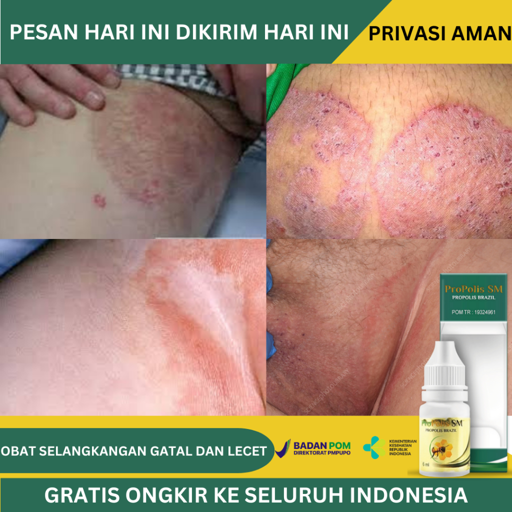 Obat Selangkangan Lecet, Obat Selangkangan Gatal Dan Perih, Obat Luka Babak Pada Selangkangan, Ruam 