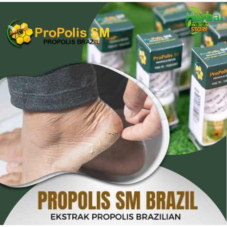 Obat Penghilang Gatal Gatel Kaki Pecah2 dan Kering | Salep Herbal Oles Untuk Menghaluskan Tumit kaki