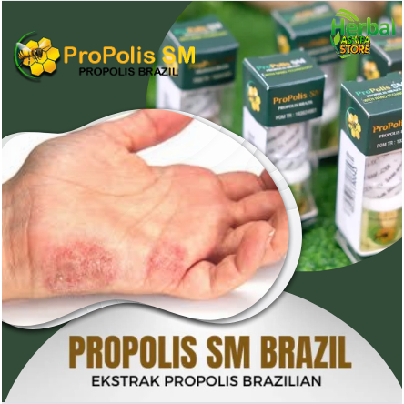 Obat Penghilang Gatal - Gatel di Bagian Dalam Jari-jari Tangan - Obat Herbal Infeksi Kulit, Skabies,