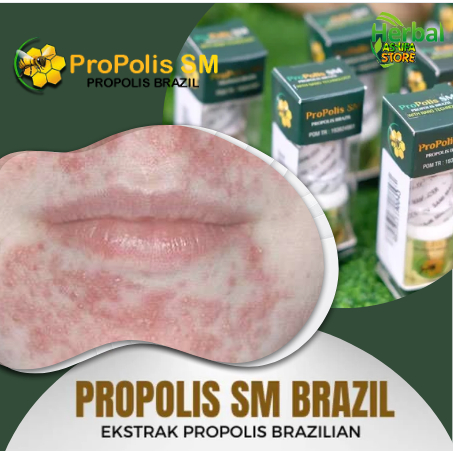 Obat Penghilang Ruam Melingkar Di Bibir Bagian Atas disertai Bibir Kering Bersisik, Obat gatal - Gat