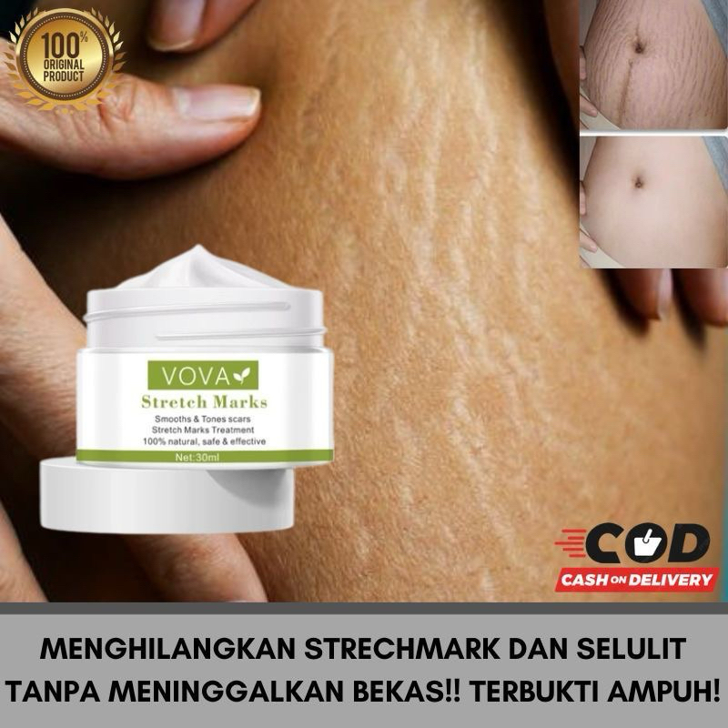 cream penghilang strechmark