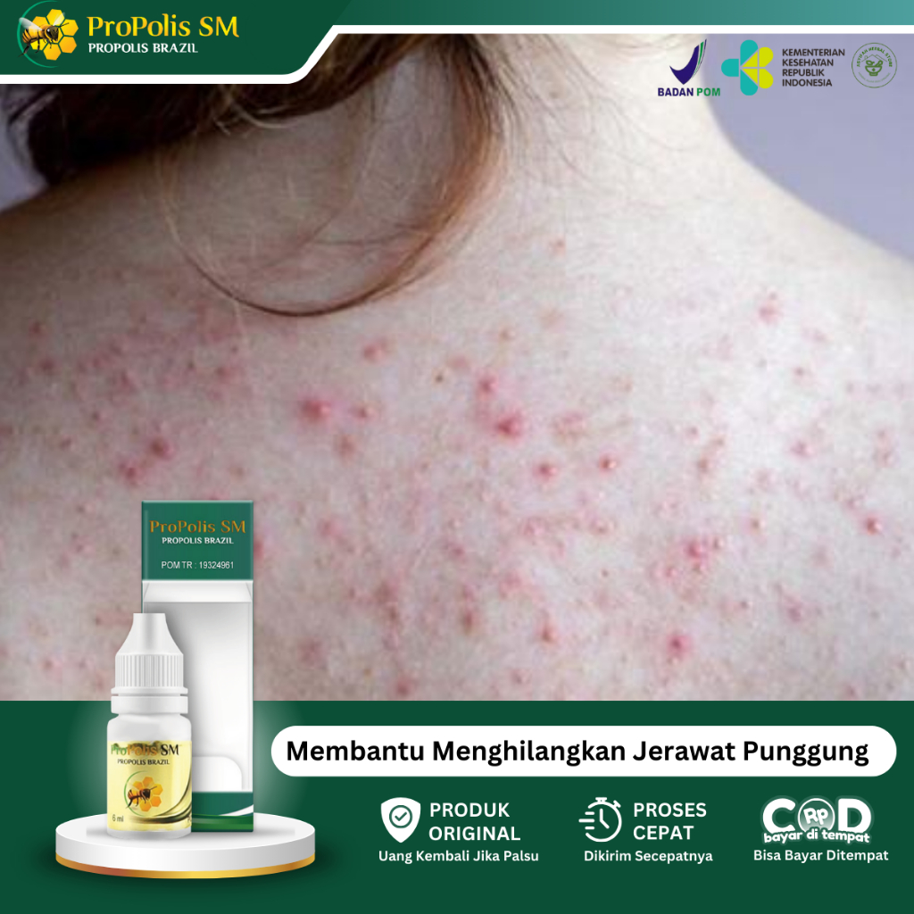 Obat Jerawat Punggung Dan Dada, Obat Pantat Bruntusan, Obat Biang Keringat, Obat Gatal Punggung, Oba