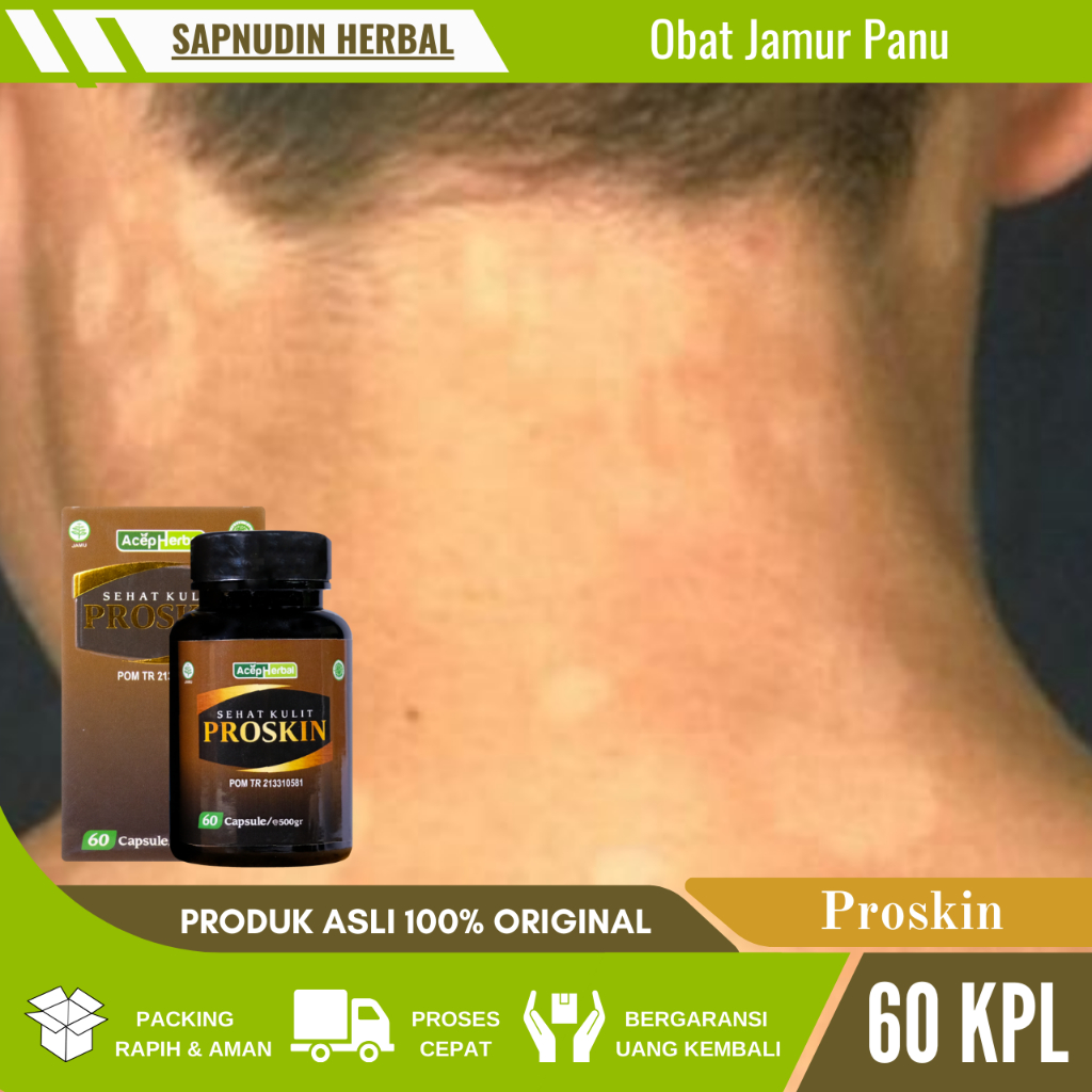 Obat Gatal Jamur Panu Paling Alami, Obat Hapuran, Obat Kadas Kurap Eksim Kutu Air Psoriasis, Obat Al
