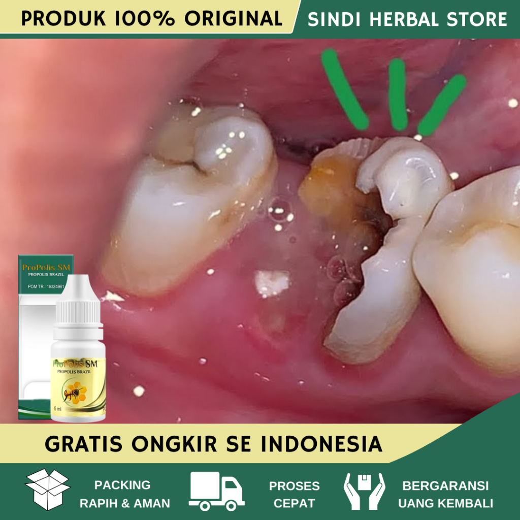 Obat Sakit Gigi, Obat Sakit Gigi Berlubang, Obat Sakit Gigi dan Gusi, Obat Gigi Berlubang, Obat Gigi