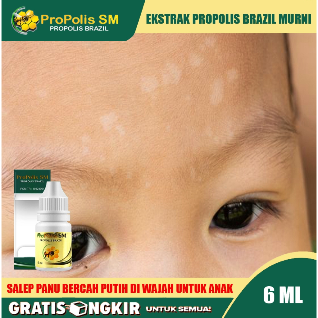 Obat Panu Anak, Di Wajah Anak, Obat oles Penghilang Panu Untuk Anak, obat panu   anak untuk di wajah