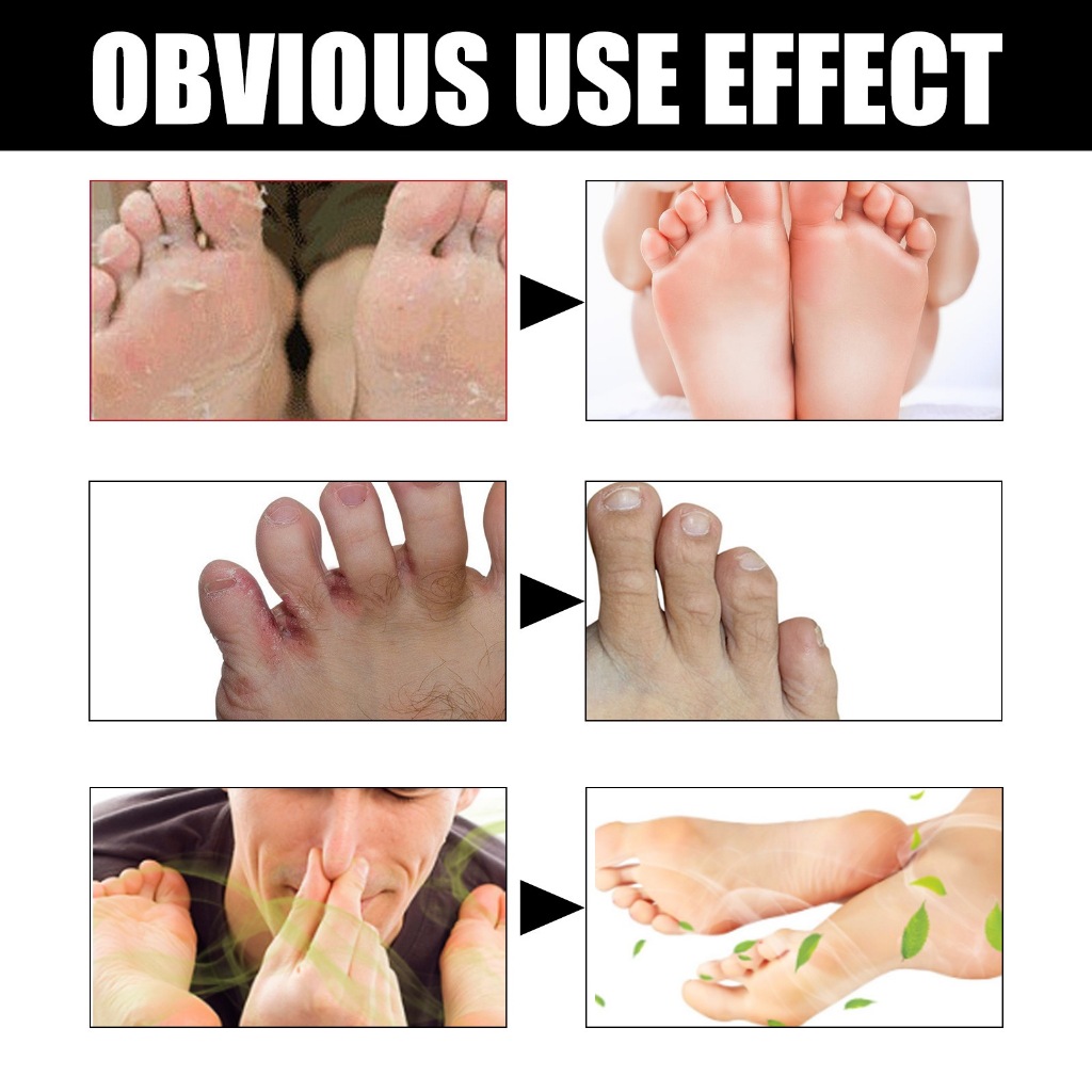 Ximonth foot deodorant cream removes athlete's foot, foot odor, prevents dry and peeling feet, and r