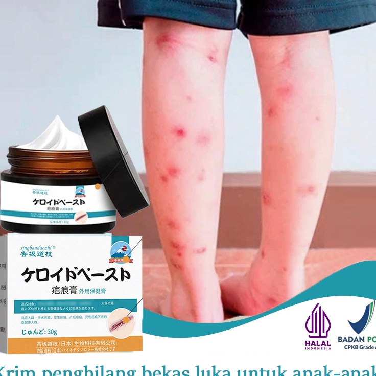 77 penghilang bekas luka hitam koreng penghilang bekas luka salep penghilang bekas luka obat penghil